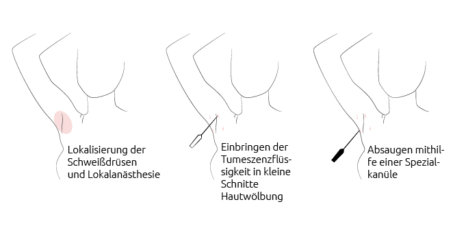 Hyperhidrose Absaugen, Faltenbehandlung & Anti-Aging in Nürnberg, Aesthetik Light 