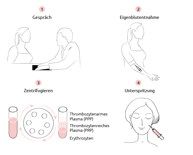 Vampir Lifting, Faltenbehandlung & Anti-Aging in Nürnberg, Aesthetik Light 